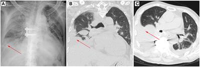 Comparison of Clinical Data Between Patients With Complications and Without Complications After Spinal Tuberculosis Surgery: A Propensity Score Matching Analysis